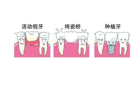 活动假牙、烤瓷牙、种植牙的区别在哪？补牙选哪个更好？